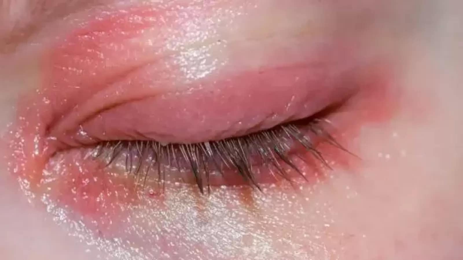 Rash around the eyes? It can be allergies, says doctor; know symptoms and 6 care tips